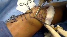 Phlebektómiával - műtéti eltávolítása a visszerek (visszér a lábak) leolvasott,