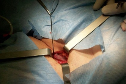 Phlebektómiával - műtéti eltávolítása a visszerek (visszér a lábak) leolvasott,