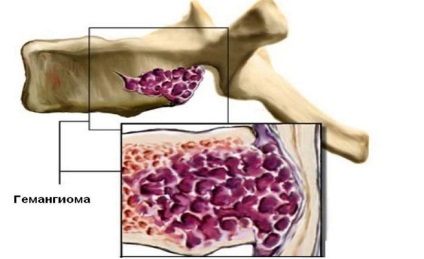 Hemangiomul coloanei vertebrale ce este, tratamentul, la adulți, coloana vertebrală lombară