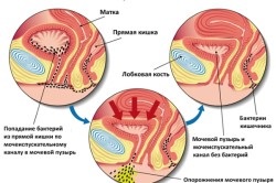 Hemoragic simptome și cauze cistite