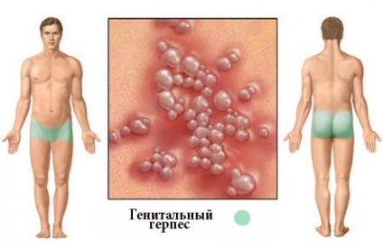 A genitális herpesz tünetek a férfiak és a következmények