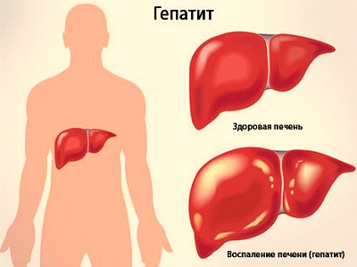 Hepatita a (boala botkinica) simptome, tratament, perioada de incubatie