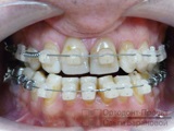Corectarea ocluziunii, deranjată de extracția dintelui precoce, pregătirea pentru proteză - Andrew F.