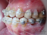 Malocclusion, károsodott korai foghúzás, fogpótlás előkészítése - Andrew F