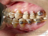 Corectarea ocluziunii, deranjată de extracția dintelui precoce, pregătirea pentru proteză - Andrew F.