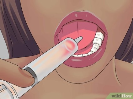 Cum să curăț un dinte de înțelepciune tăiat parțial