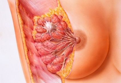 Ce chisturi ale glandelor mamare se pot dezvolta în cancer