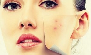 Cum sa curatati porii de acnee si acasa
