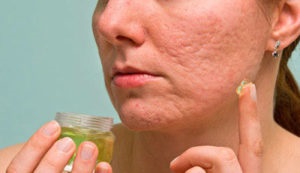 Cum să eliminați cicatricile de pe acnee pe față acasă