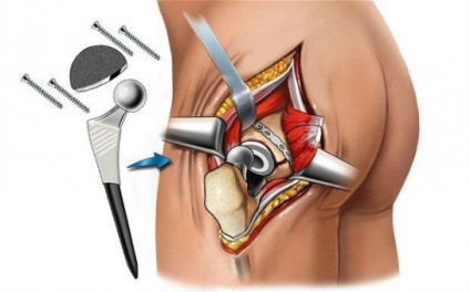 Hogyan lehet gyógyítani a csípőízület arthrosis (coxarthrosis) a betegeket, hogyan kell megállítani a fájdalmat