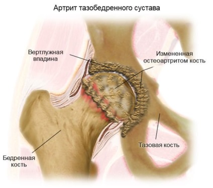 Hogyan lehet gyógyítani a csípőízület arthrosis (coxarthrosis) a betegeket, hogyan kell megállítani a fájdalmat