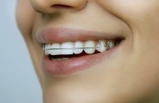 Hogyan, hogy összehangolják a fogak otthon és korrekt harapás