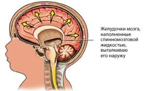 Chistul creierului ce este, simptomele și tratamentul
