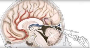 Chistul creierului ce este, simptomele și tratamentul