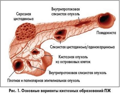 Ciszta a hasnyálmirigy előrejelzés