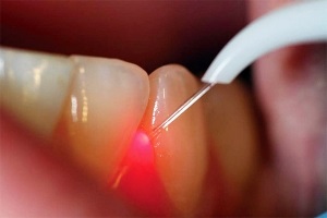 Chistul dintelui - tratamentul fără îndepărtare la rădăcină, inter-rădăcină, examinare preventivă și radiografie în