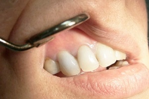 Chistul dintelui - tratamentul fără îndepărtare la rădăcină, inter-rădăcină, examinare preventivă și radiografie în