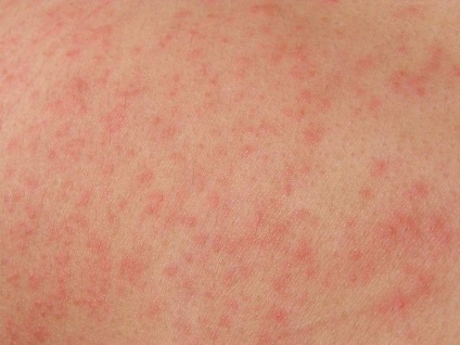 Urticaria gyermekeknél a tünetek és a kezelés, fotó