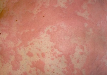 Urticaria gyermekeknél a tünetek és a kezelés, fotó