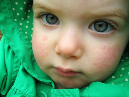Urticaria gyermekeknél a tünetek és a kezelés, fotó