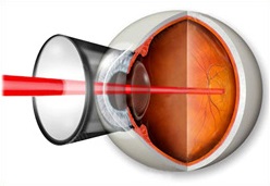 Coagularea prin laser a retinei