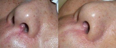 Îndepărtarea facială laser - populară procedură cosmetică