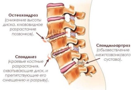 Exerciții terapeutice în spondiloza coloanei vertebrale toracice