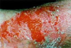 Tratamentul cu remedii folclorice pentru eczeme