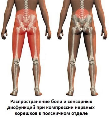 Tratamentul proeminențelor discurilor coloanei vertebrale din gimnastica din regiunea lombară, exerciții, lfc