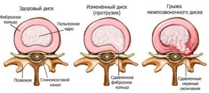 Tratamentul proeminențelor discurilor coloanei vertebrale din gimnastica din regiunea lombară, exerciții, lfc