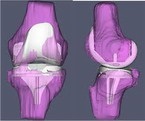 patella ínszakadás Kezelés