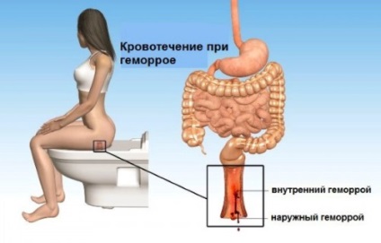 Tratamentul hemoroizilor interni cu sângerare