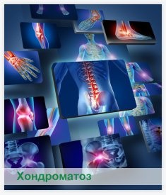 Kezelés chondromatosis csípő, térd, könyök, boka, ízületi fájdalom