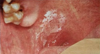 Leucoplazia a simptomelor cavității orale și a modurilor de tratament