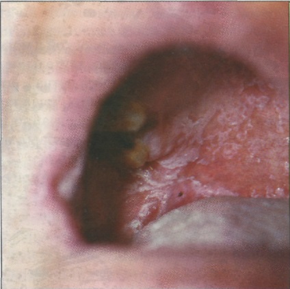 Leucoplazia a simptomelor cavității orale și a modurilor de tratament