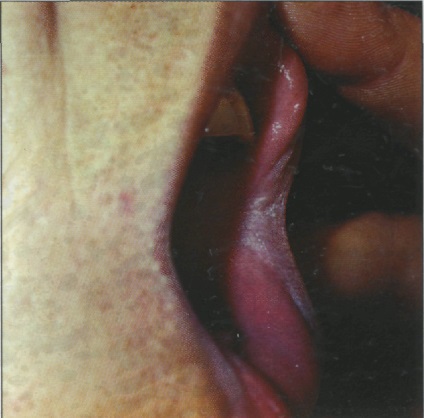 Leucoplazia a simptomelor cavității orale și a modurilor de tratament