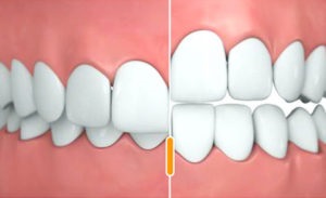 Fém fogszabályozó - típusok, jellemzők, az ár - Dr. fogat