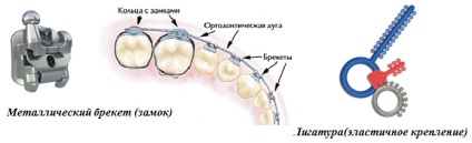 Fém fogszabályozó - típusok, jellemzők, az ár - Dr. fogat