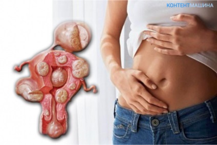 Myoma de chirurgie uterului și tratamentul bolii