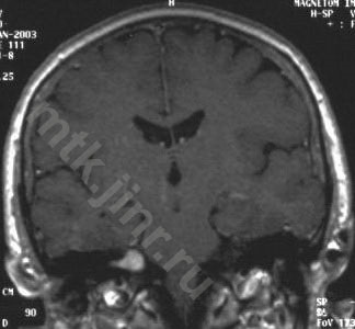 Mtk - neuroma a nervului auditiv