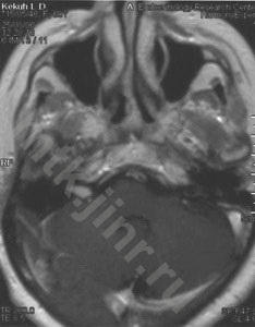 Mtk - neuroma a nervului auditiv