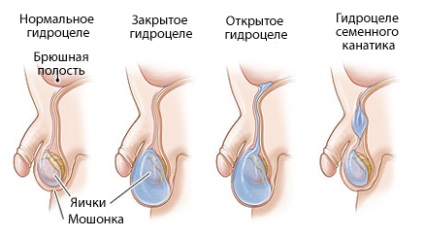 Operațiuni pentru hidrocele (testicule lipicioase)