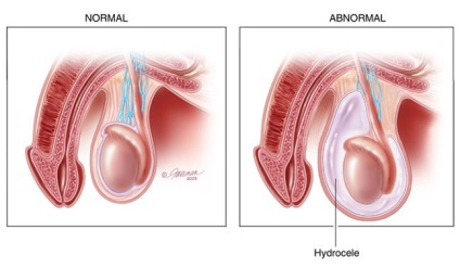 Operațiuni pentru hidrocele (testicule lipicioase)