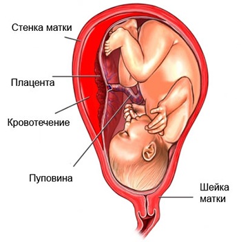 Detașarea simptomelor placentei, tratamentul și prevenirea