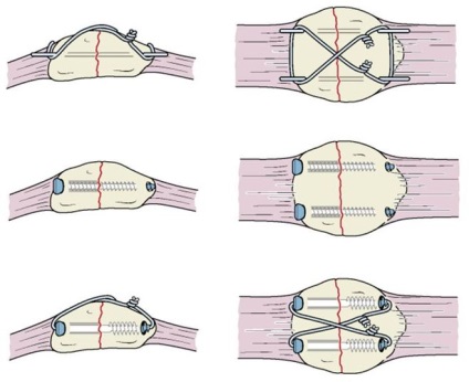 Fractura de patella