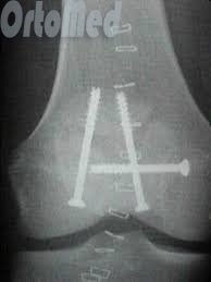 Fractura de simptome ale patelelui, tratament, interventie chirurgicala, reabilitare, fractura de patella