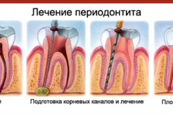 Diagnosticul parodontitei, simptomele și complicațiile