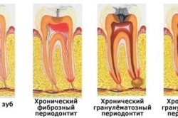 Diagnosticul parodontitei, simptomele și complicațiile