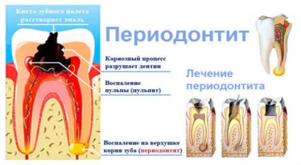 Parodontitele cauze, clasificare și metode de tratament