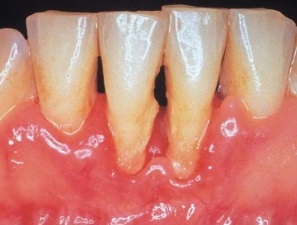 periodontitis tünetei